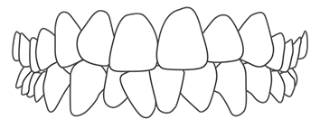 Show crowded teeth malocclusion