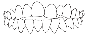 Show openbite malocclusion