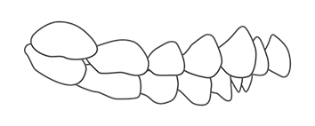 Show protrusion malocclusion