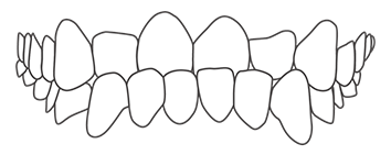 Show underbite malocclusion